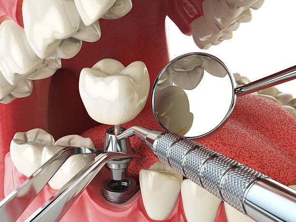 Best Broken or Chipped Tooth Repair in Stockton, KS